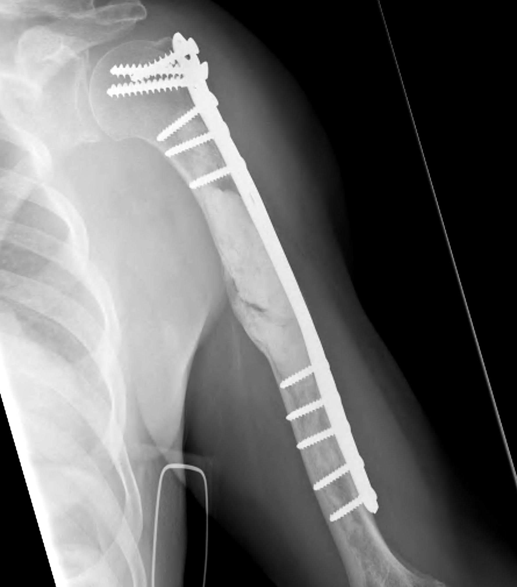 Metastasis Humerus Plate PMMA0002